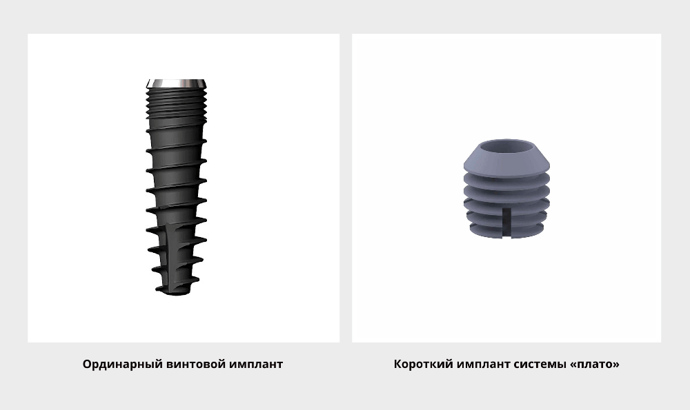 короткие зубные импланты