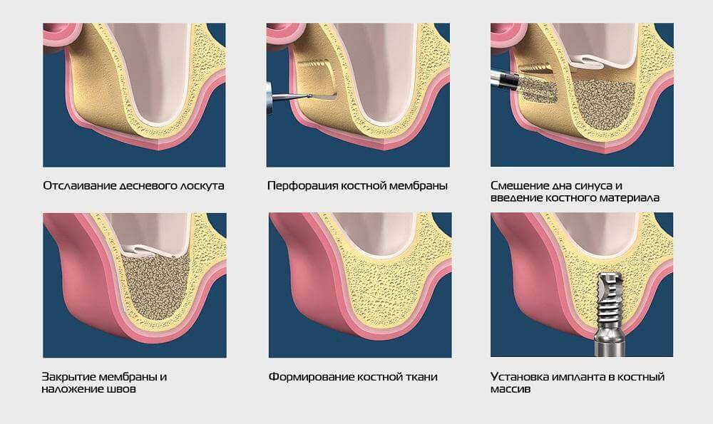 Sinus Lift Surgery