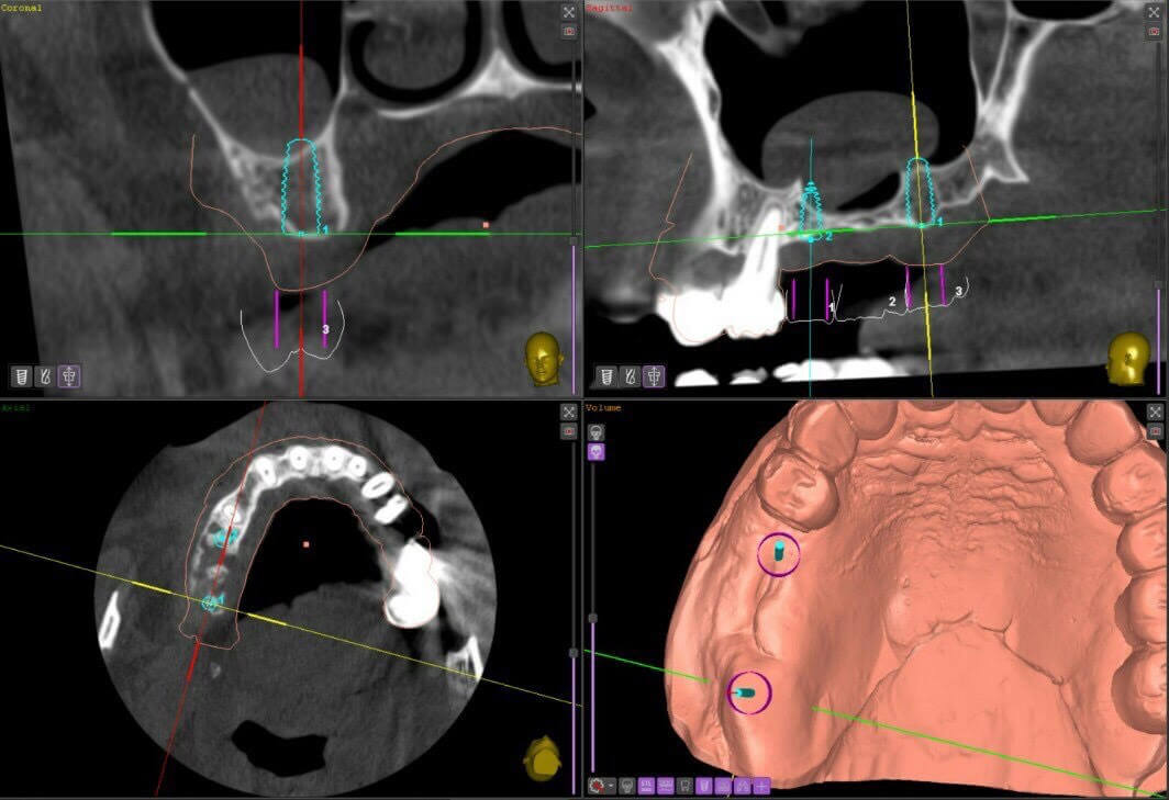 Planning a dental implant operation