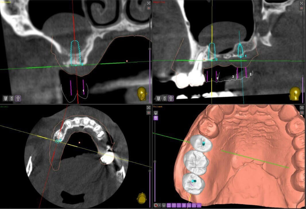 Planning a dental implant operation