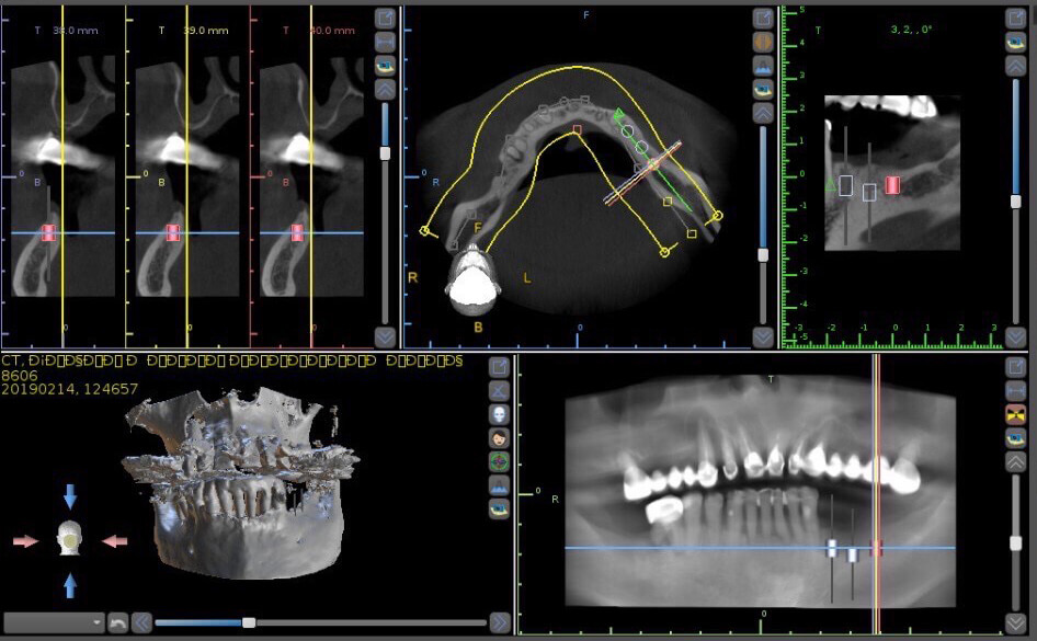 Planning a dental implant operation