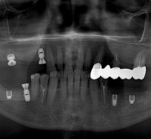 снимок после имплантации зубов
