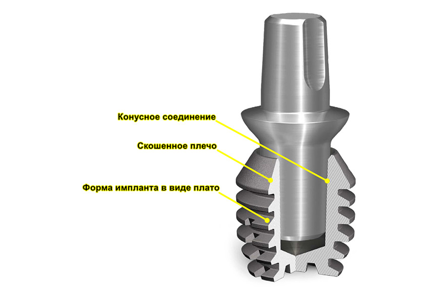 Преимущества коротких имплантов