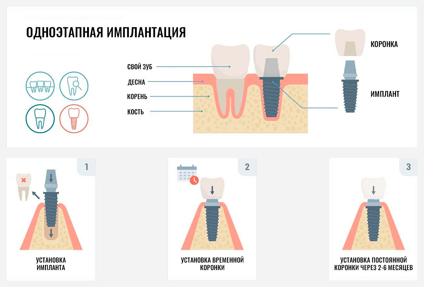 одноэтапная имплантация зубов